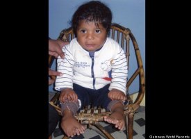 Most Fingers And Toes