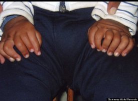 Most Fingers And Toes