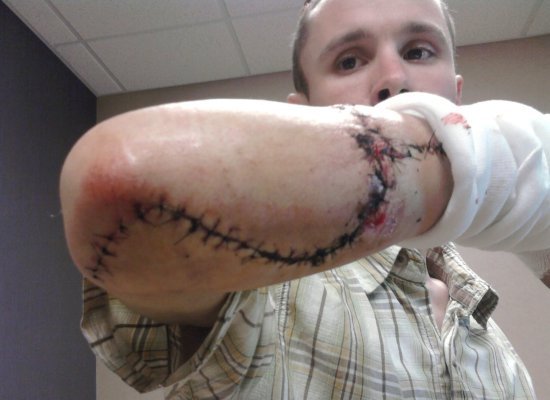 Table Saw Accident Victims Plea For Safety Standards (GRAPHIC PHOTOS)