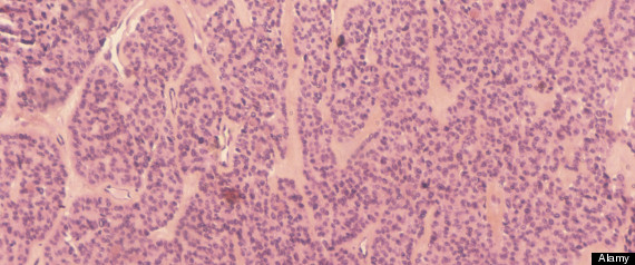Ovarian Screening