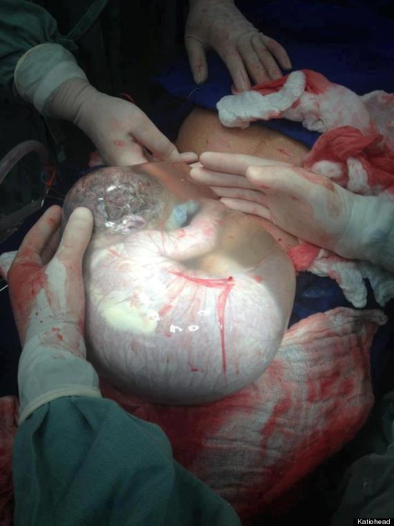 Bebé nacido con el saco amniótico intacto O-BEBE-SACO-AMNIOTICO-570