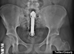 Man Wedges Dildo Up His Butt, Livetweets Extraction (TWEETS)