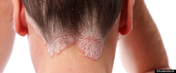 Eczema Treatment