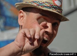 AMAZING PHOTOS: Man Can Stick Finger Through Eye Socket