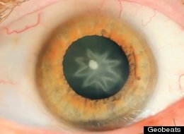 LOOK: Man Gets Punched In Eye, Develops Star-Shaped Cataract