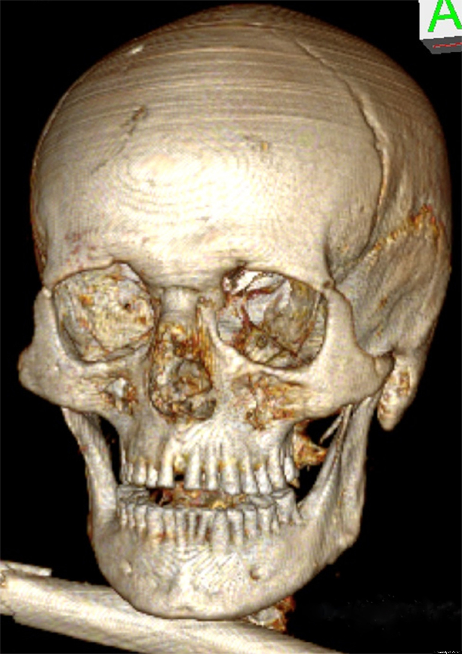 teeth otzi iceman mummy bad had before dental wet disease oldest ötzi skull oetzi human prehistoric condition science strange head