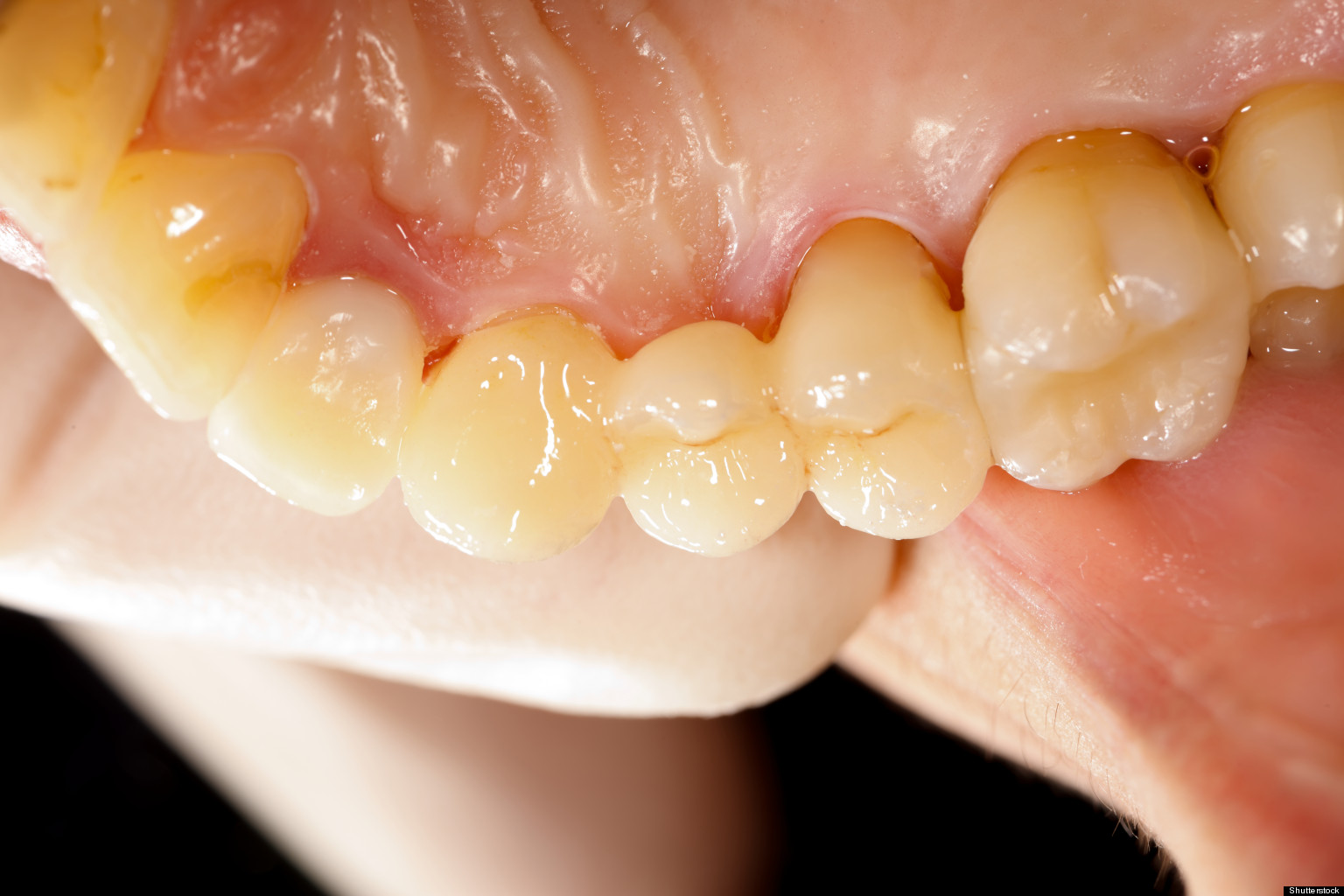 Arkansas Dental Patients Possibly Exposed To Infectious Materials By