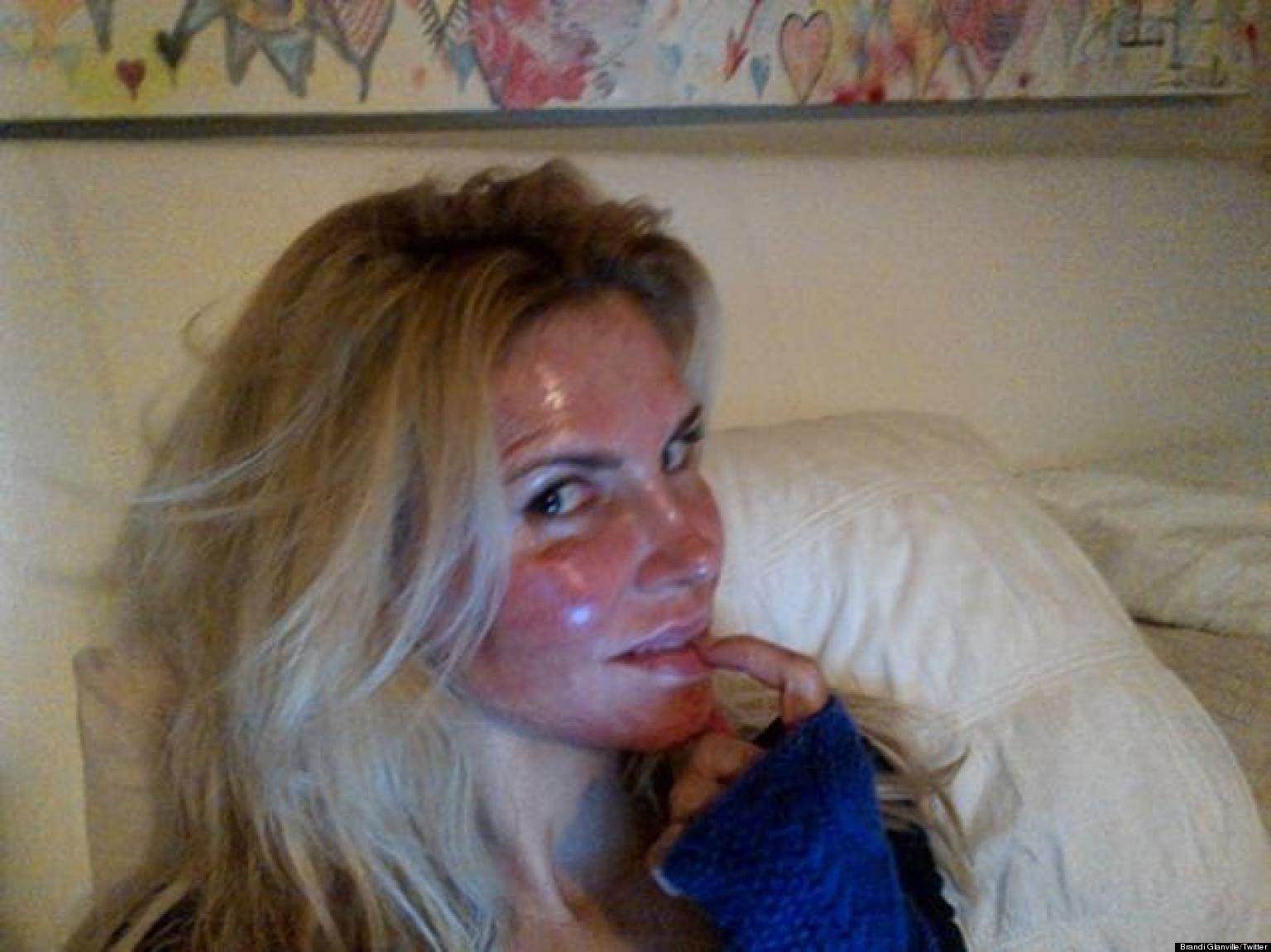 Brandi Glanville's Burned Face After Laser Treatment Is ...