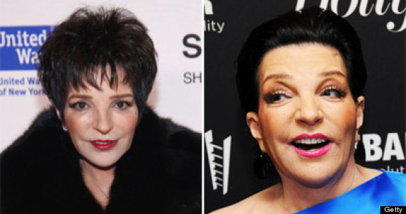 liza minnelli plastic surgery