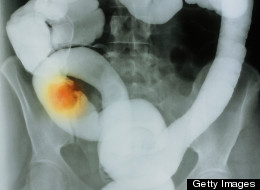 Nuevo examen para la detección del cáncer colorrectal