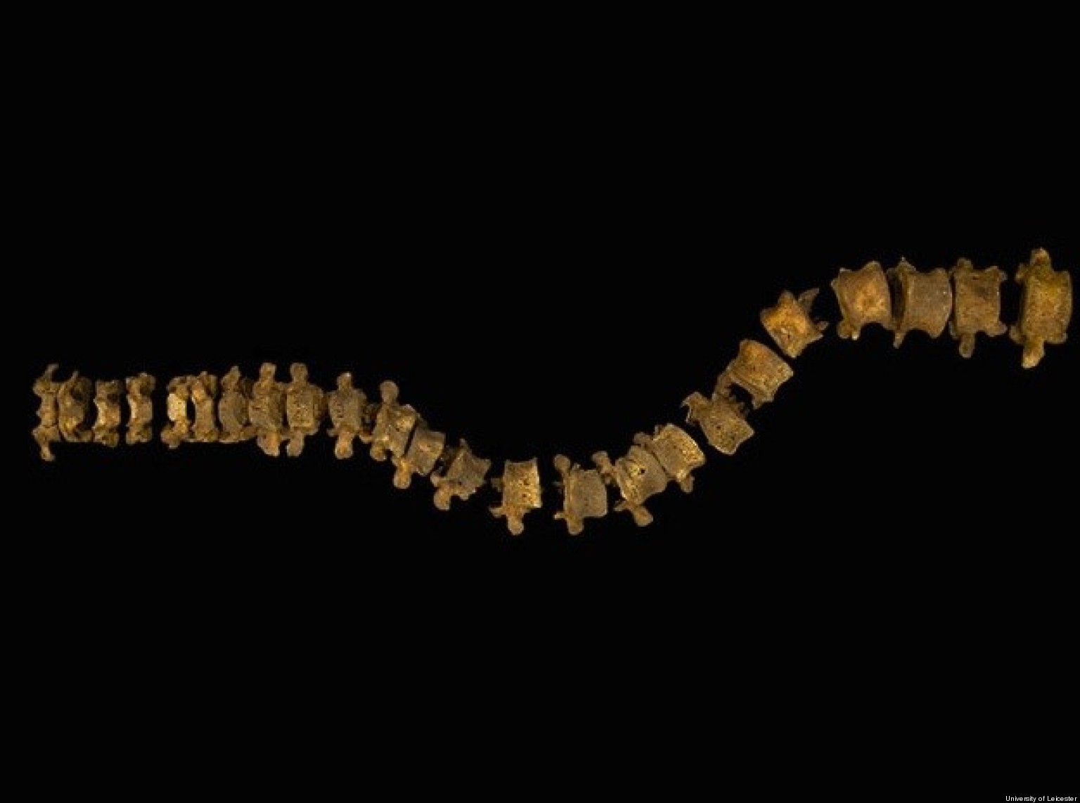 Richard III Scoliosis King May Have Had Painful Spine Treatments