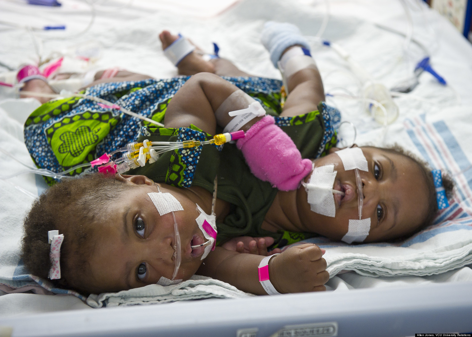 Conjoined Twins Azhari And Azhiah Jones Separated In Rare Phased 