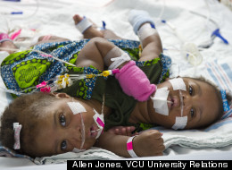 PHOTOS: Conjoined Twins Undergo First-Of-Its-Kind Surgery