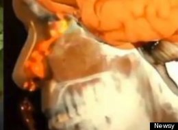 SNOT GOOD: Man's Leaky Brain Fluid Mistaken For Runny Nose