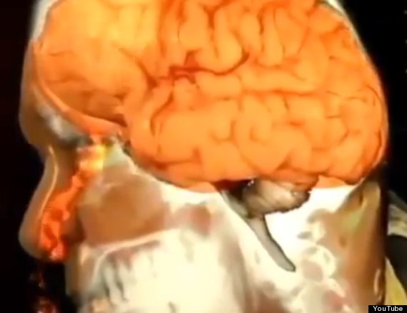 Man With Leaking Brain Fluid Thought He Just Had Allergies A