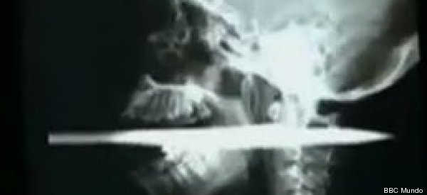 Una mujer brasileña sobrevive tras atravesarle el cuello un arpón (FOTOS)