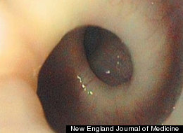 Bizarre Anatomy Explains Woman's Painful Spasms, Doctors Say