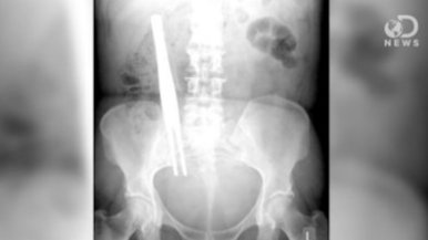 XRay