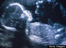 Prenatal Testing: It's Just Information, Not Answers -- or a Guarantee