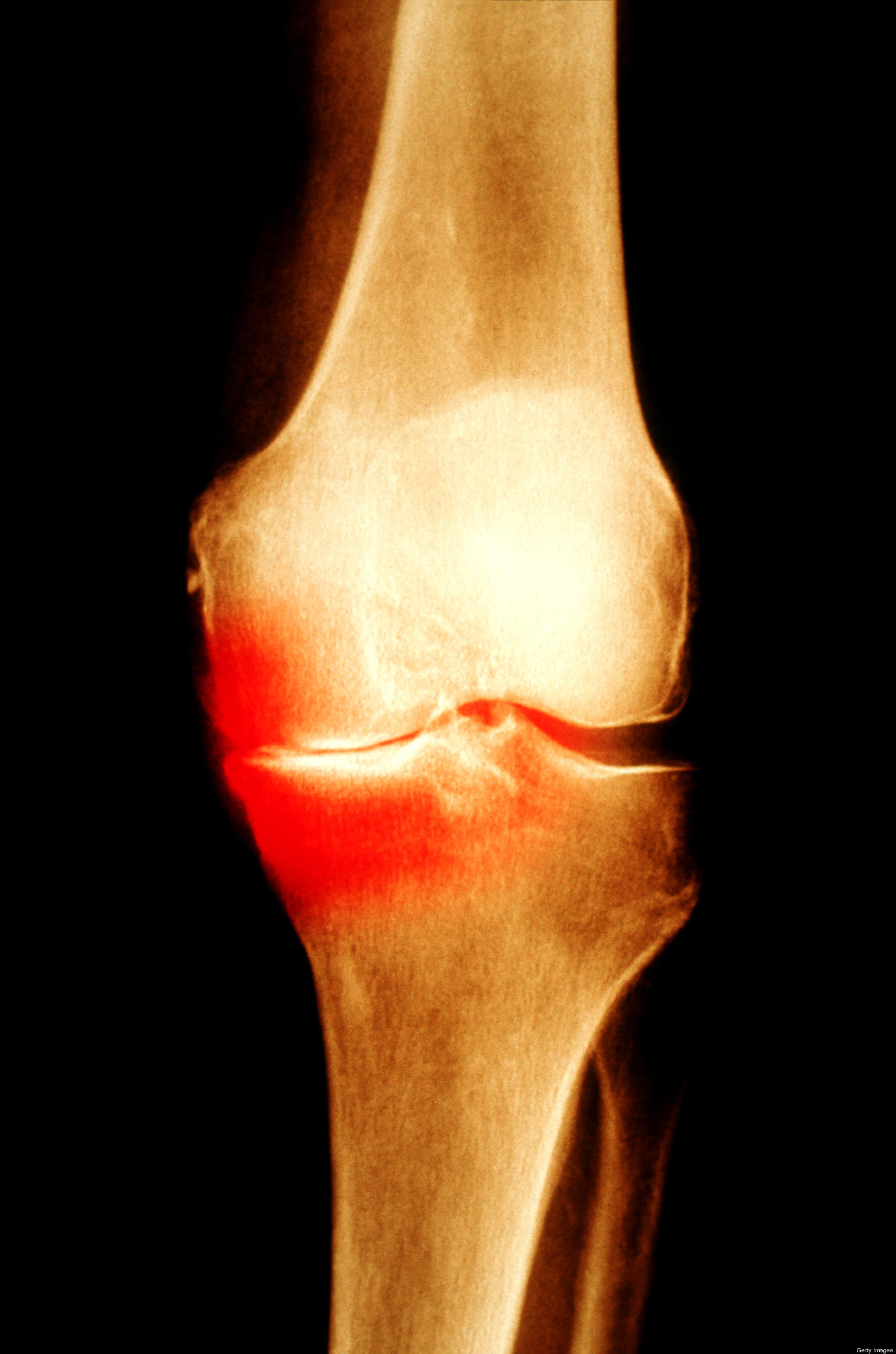Why Do Some Sports Injuries Develop Into Osteoarthritis? HuffPost UK