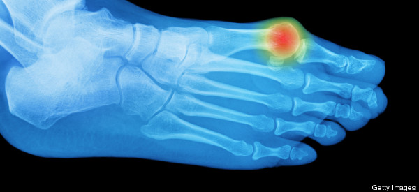 This Could Be Why You Have Bunions