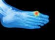 This Could Be Why You Have Bunions