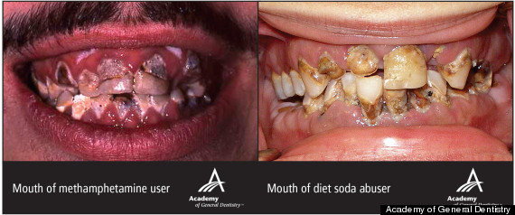 DIET-SODA-TEETH