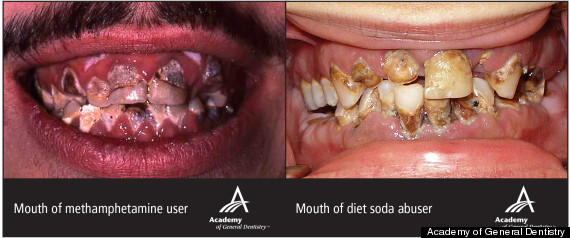 Diet Soda Teeth