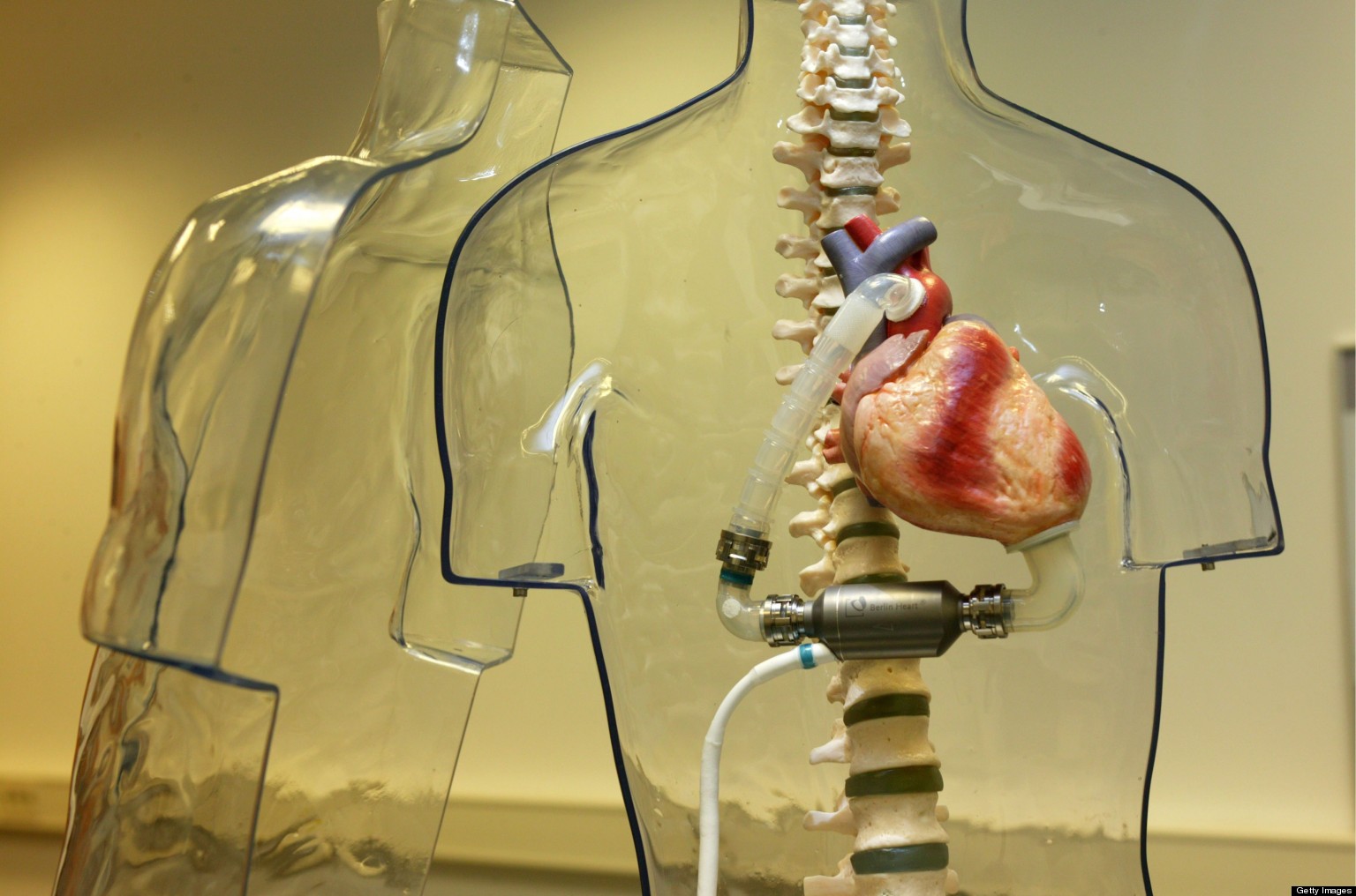 Mexico Surgeons Perform First Artificial Heart Implant In Latin America