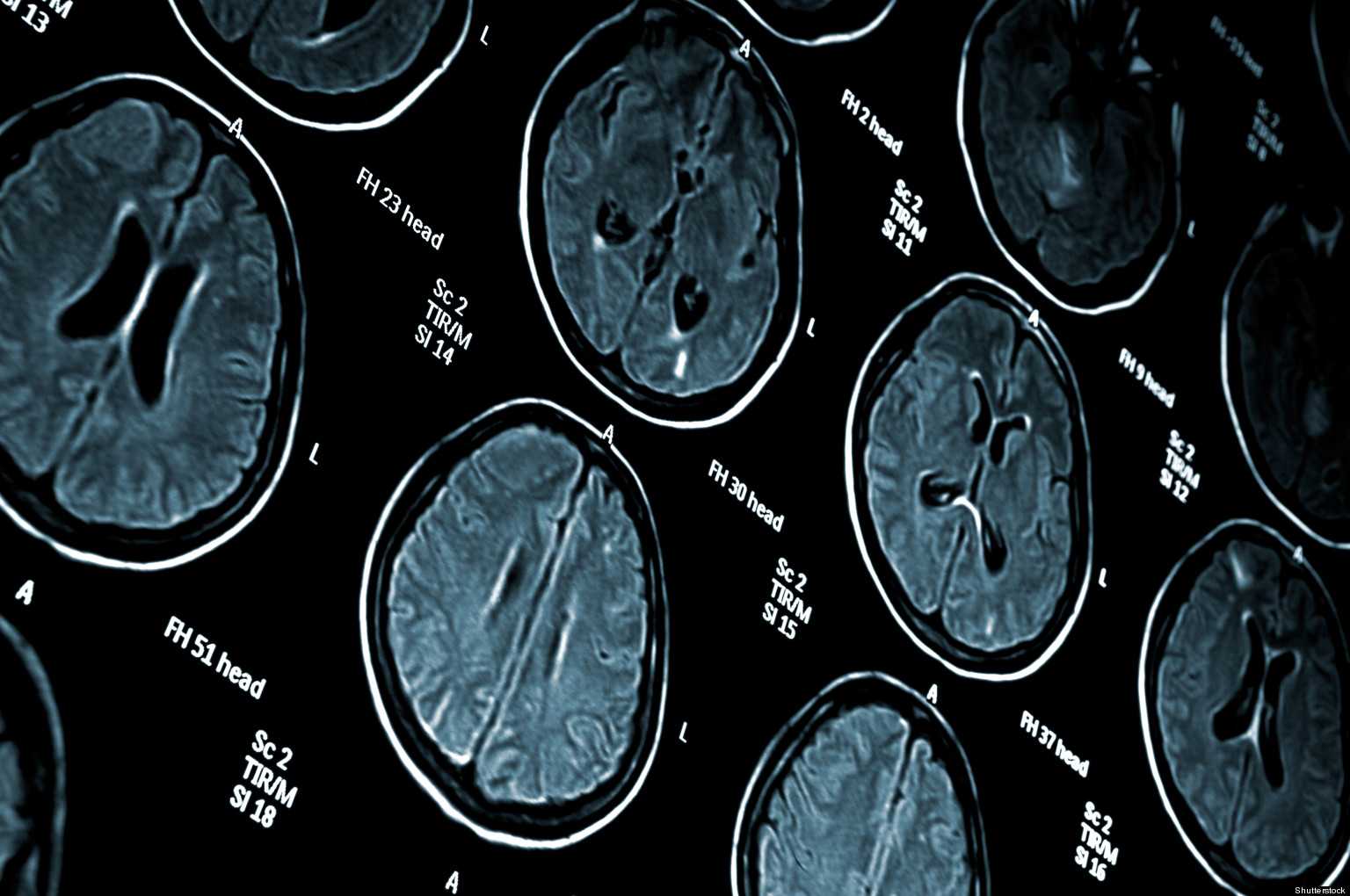 Brain Scan Hints At Best Treatment for Depression