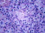 Cancer Metastasis