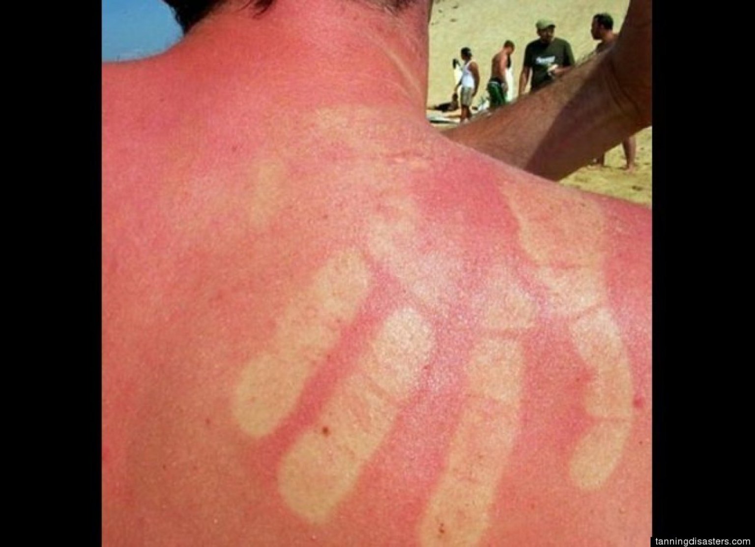 Coup De Soleil Jambes Impossible De Marcher Insolite: les pires coups de soleil (PHOTOS)