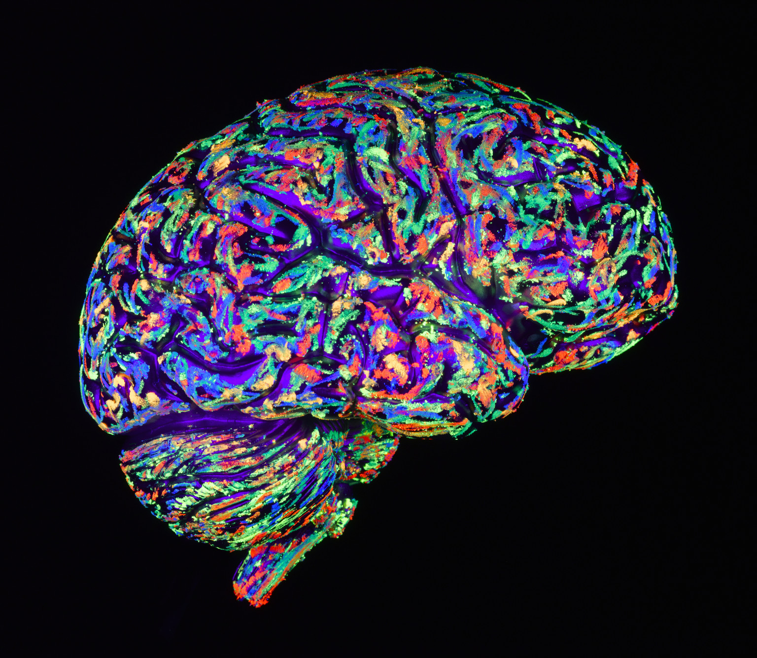 Sensory Processing Disorder Linked With Brain Structure Differences