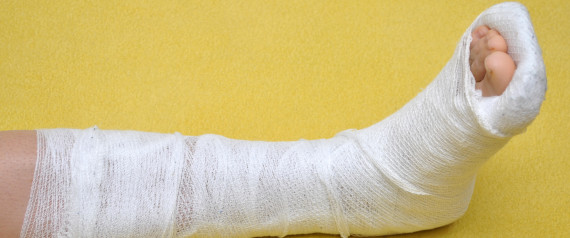 When To Fix A Broken Ankle 