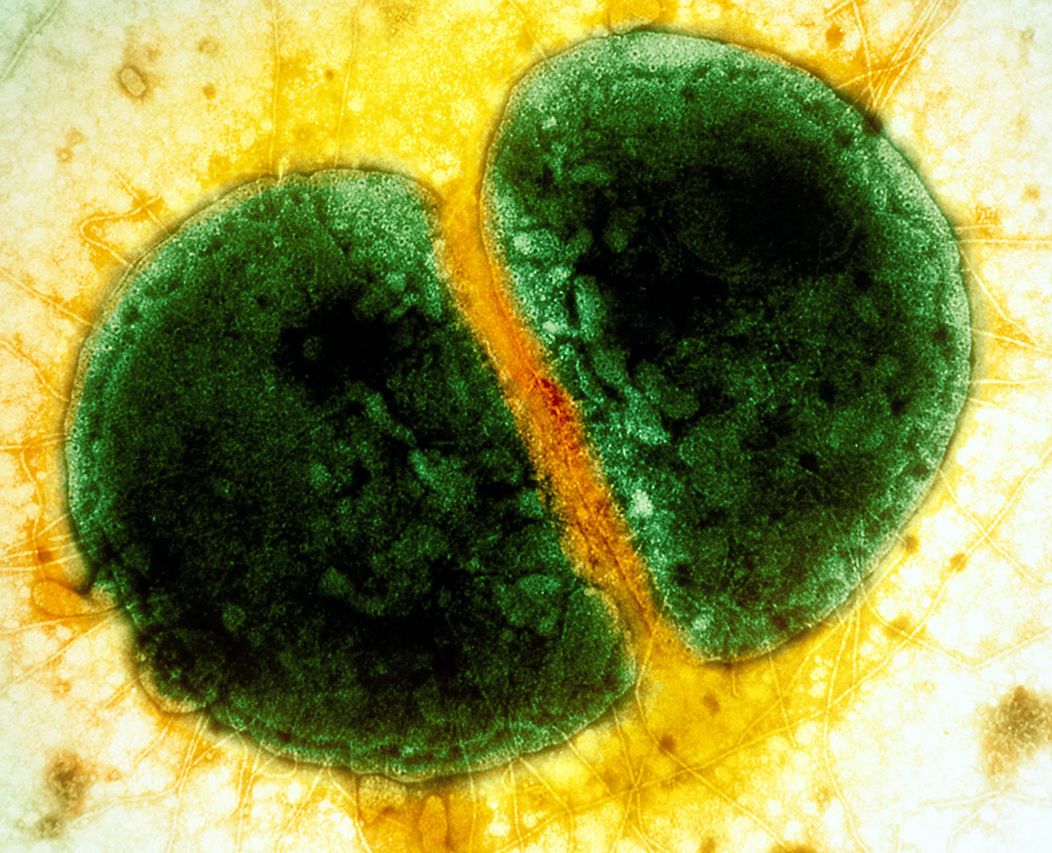 Gonorrhea Superbug Adapts To Resist Antibiotics Through 'Evolution In
