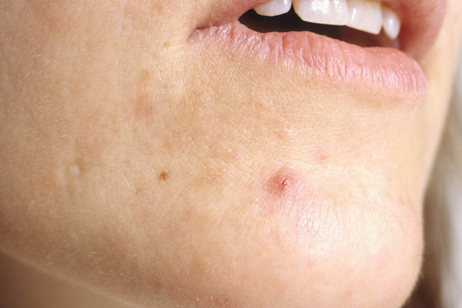 Can Mold Cause Acne Breakouts