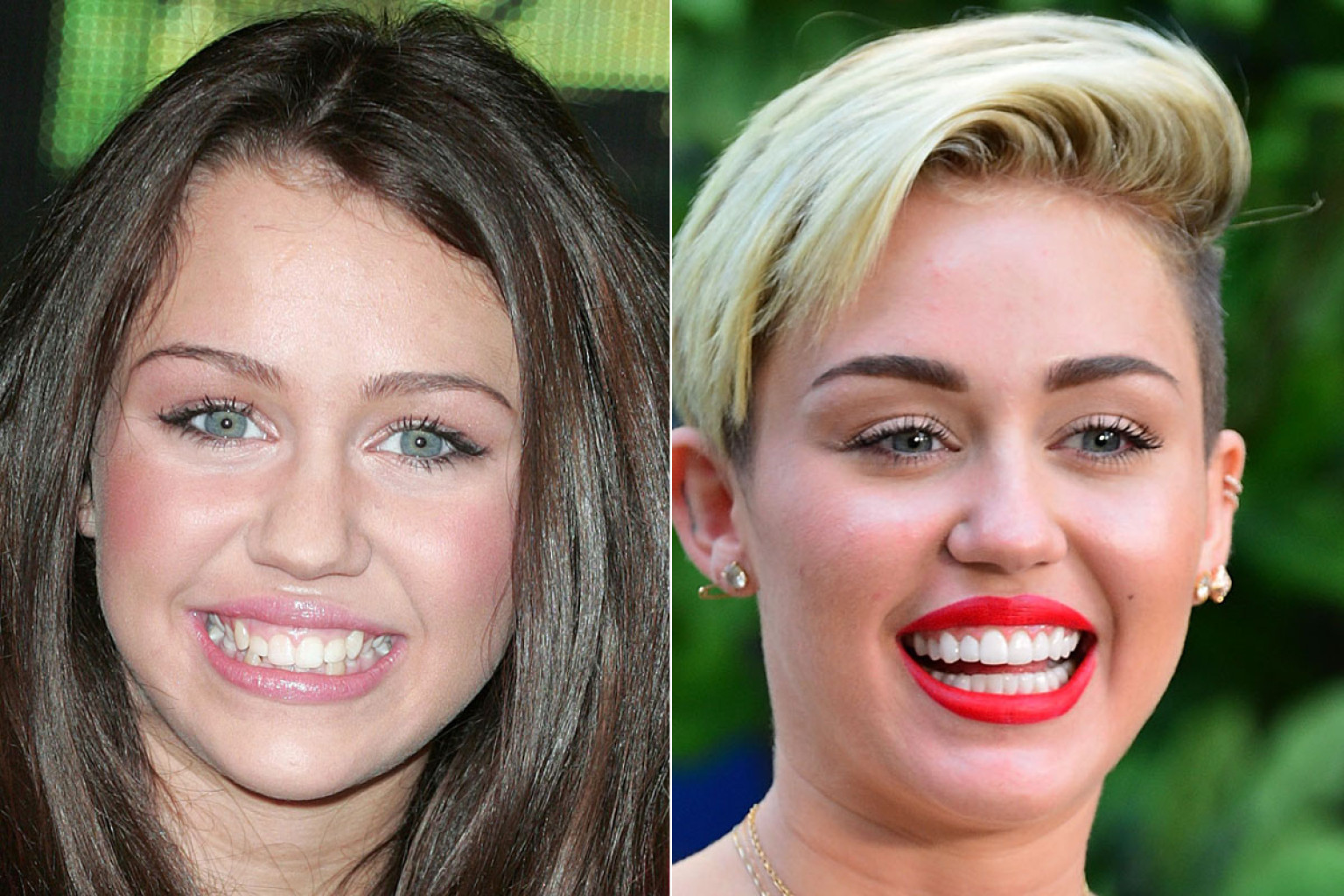 Celebrity Smiles before and after | Porcelain Veneers The Process