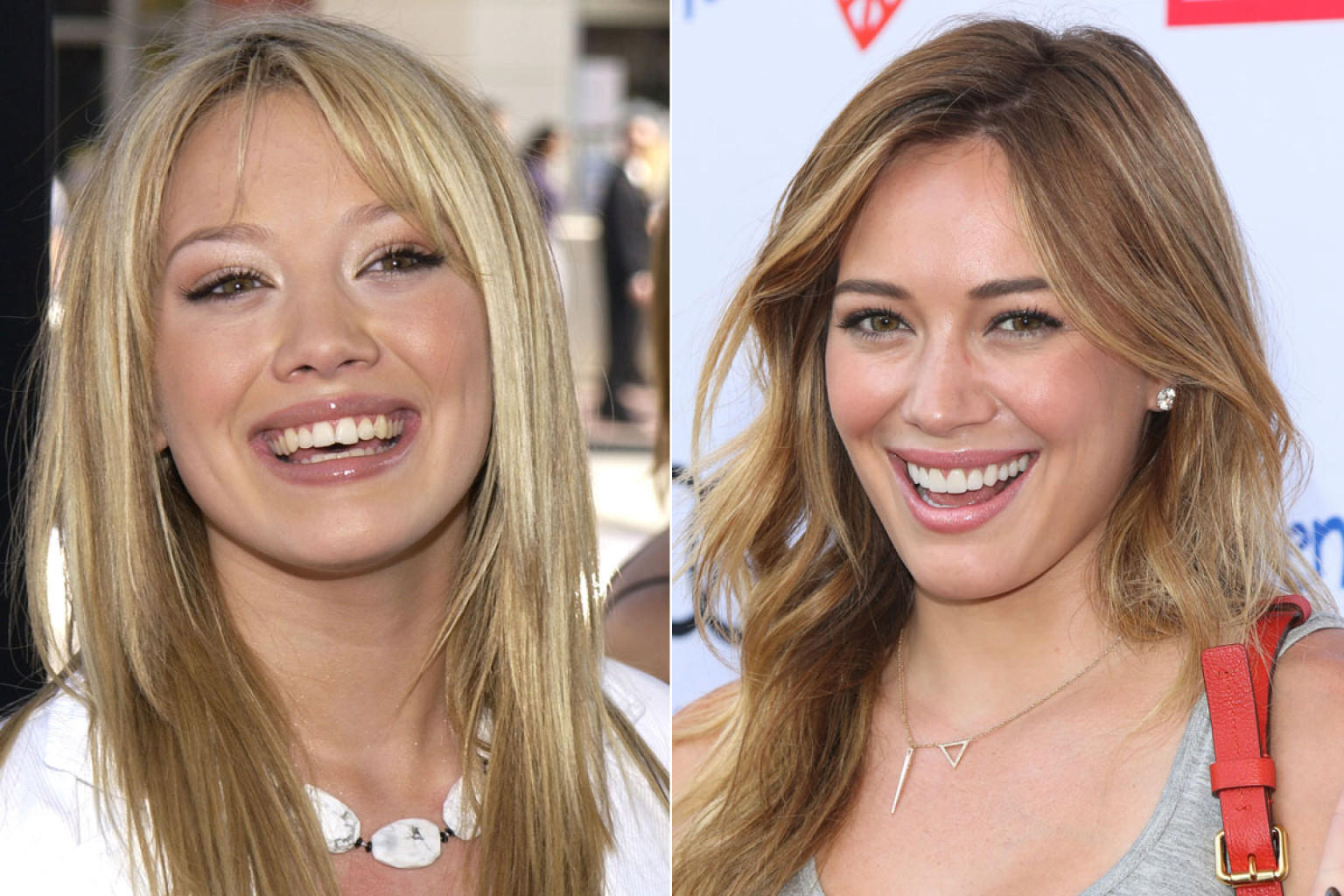 Celebrities Gone Dental: Before And After Photos Of Toothy