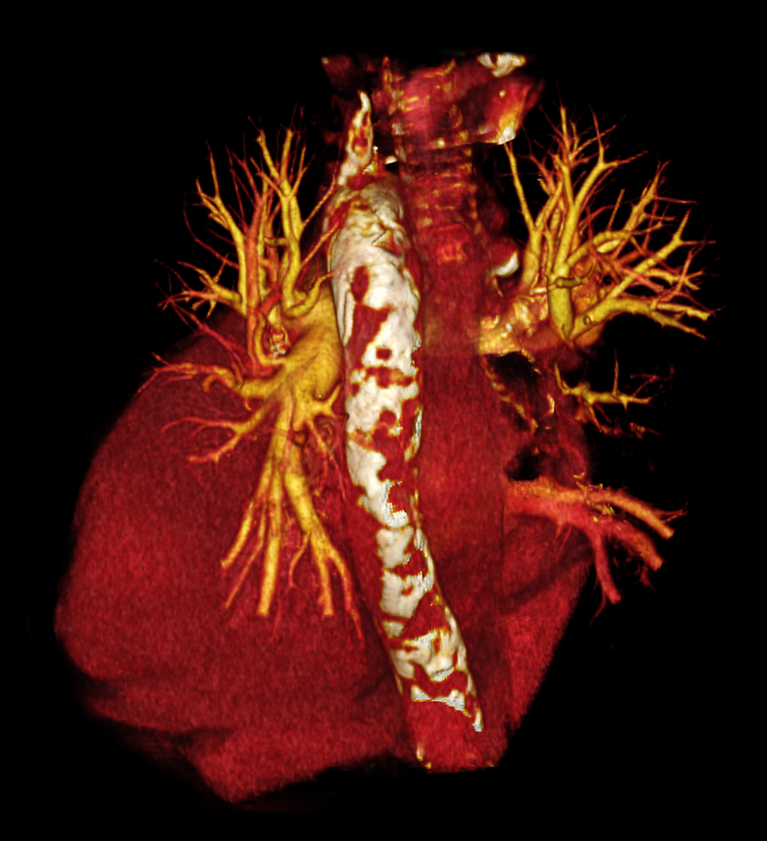 New Understanding Of Atherosclerosis Could Change The Way We Treat