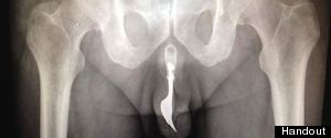 Man Fork Urethra