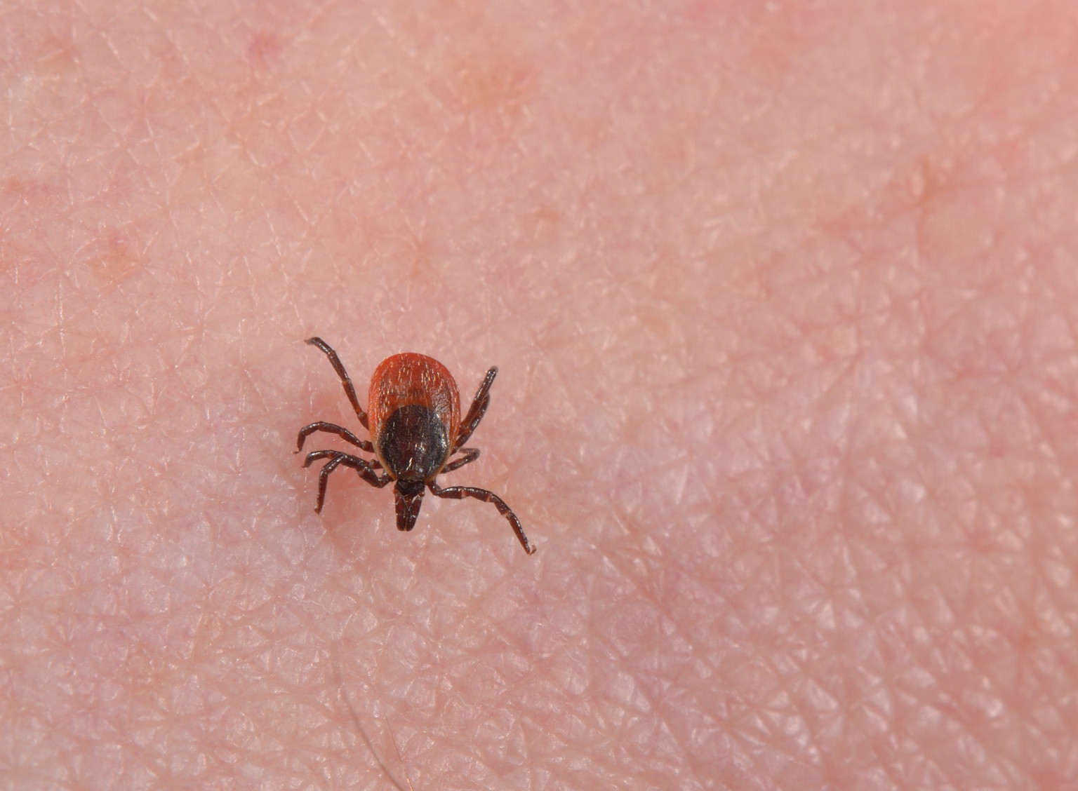 pictures-of-lyme-disease-pictures-photos