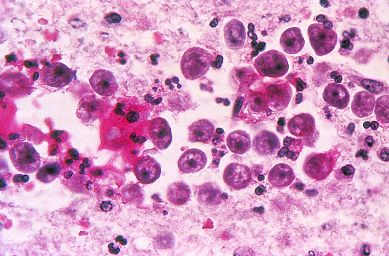 naegleria-fowleri-amoeba-or-brain-eating-amoeba-infection-and-treatment