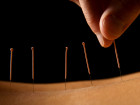 How People With Depression Could Benefit From Acupuncture