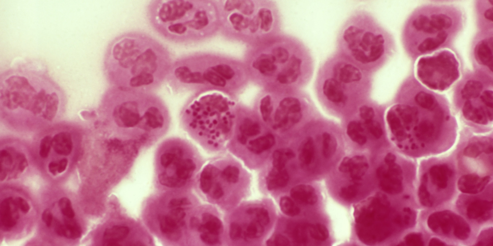 Potential CancerFighting Drug Could Also Thwart AntibioticResistant