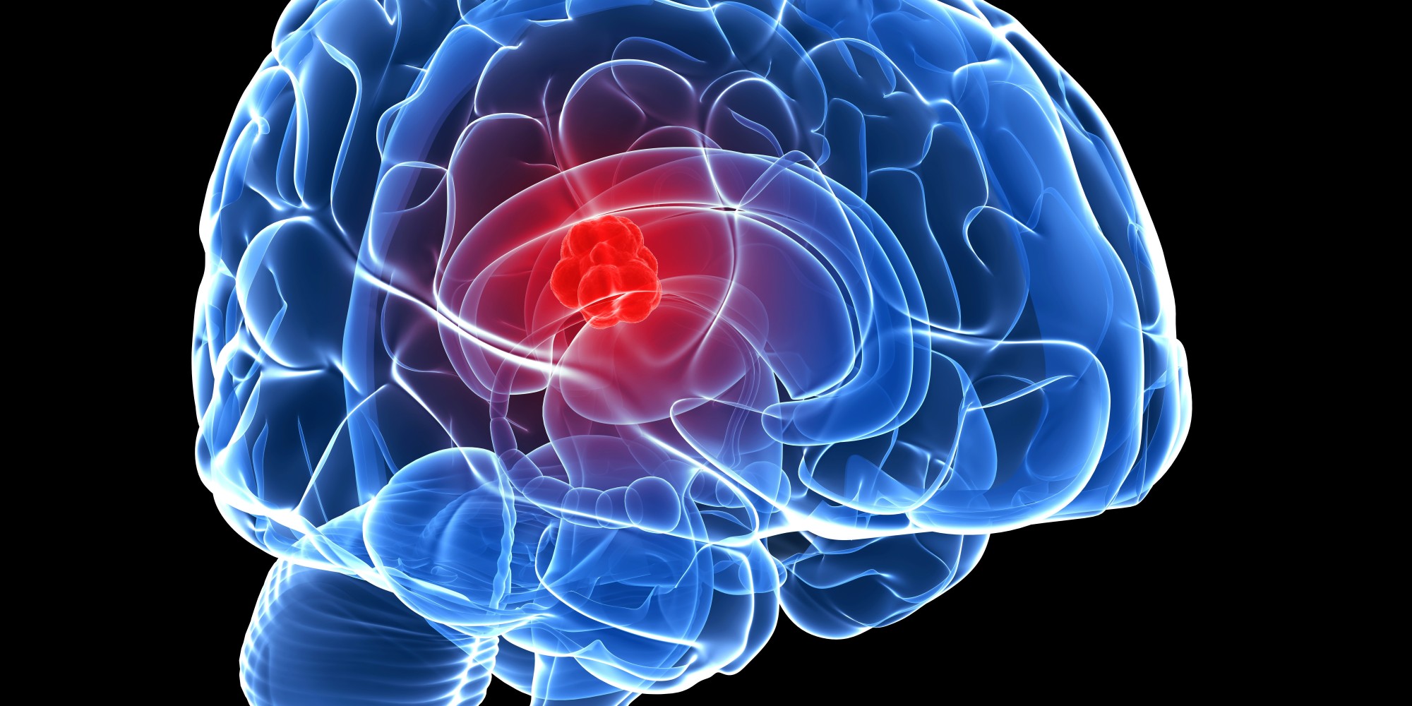 brain-cancer-sufferers-given-new-hope-with-treatment-that-allows