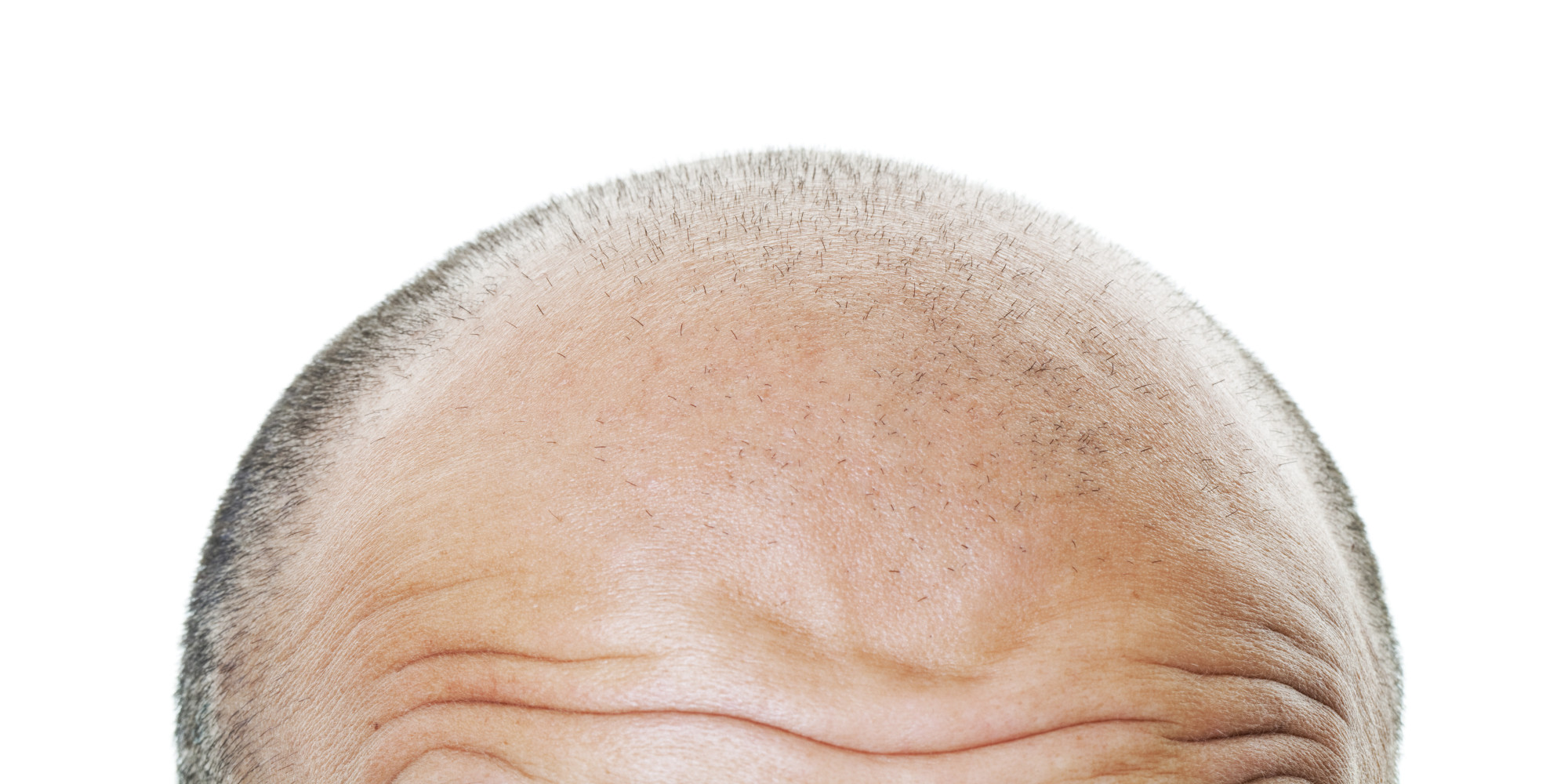 New Hair Loss Treatment Uses Baby Foreskins