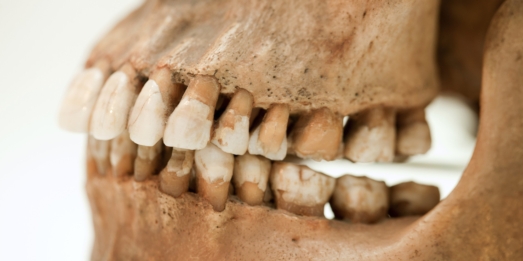 Nocturnal Teeth Grinding May Suggest a Sleep Disorder