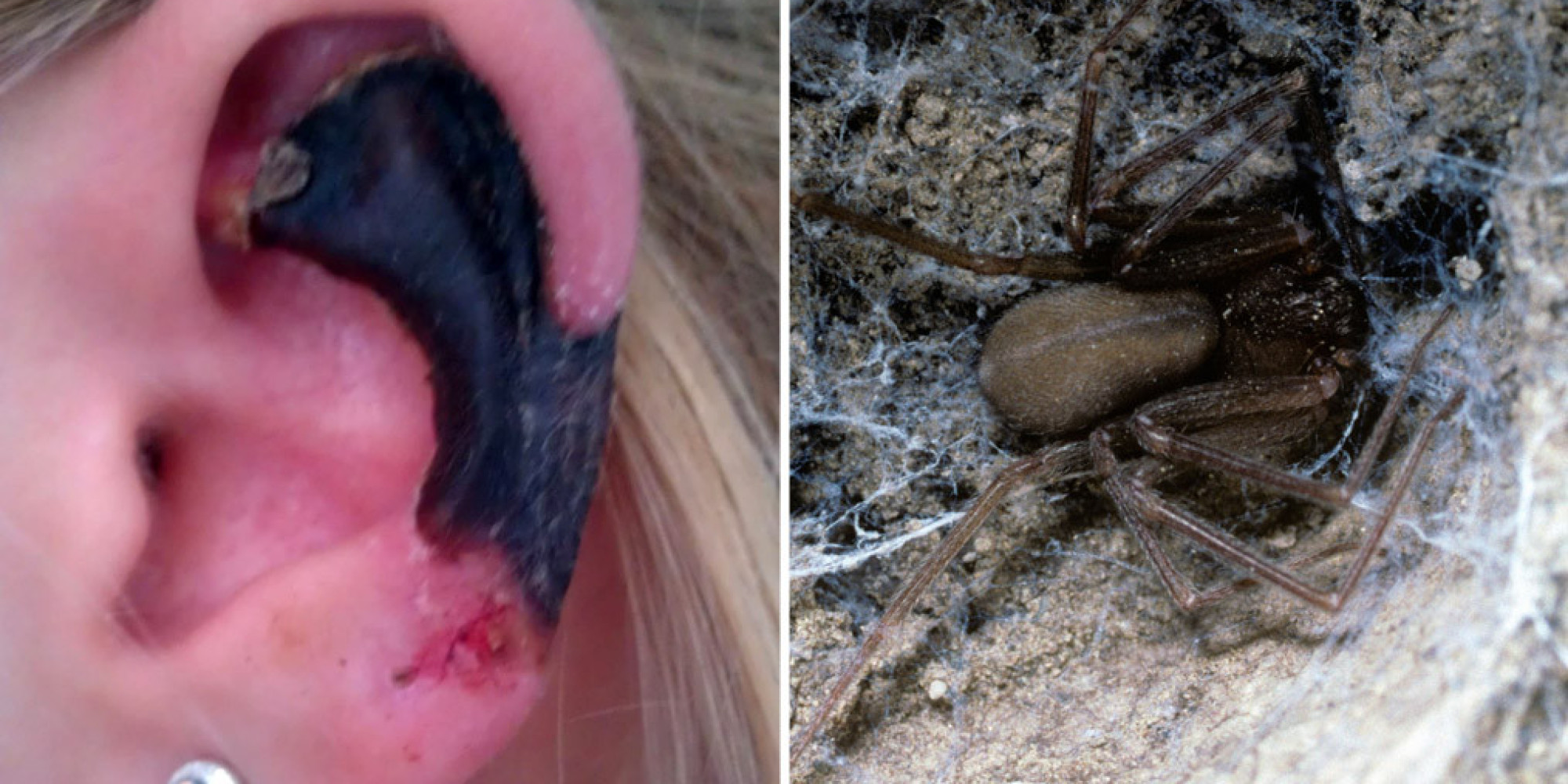 Mediterranean Recluse Spider Bite Eats Hole In Young Womans Ear