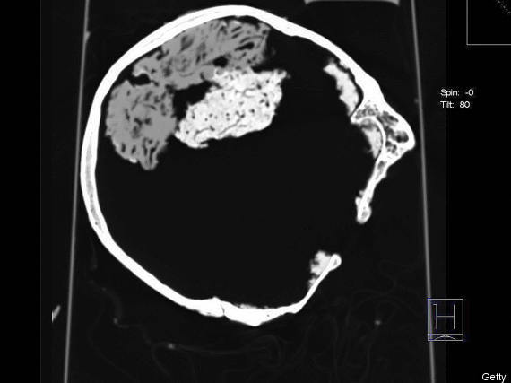 Ryan Westmoreland Brain Surgery