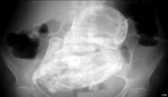 40 year old stone baby